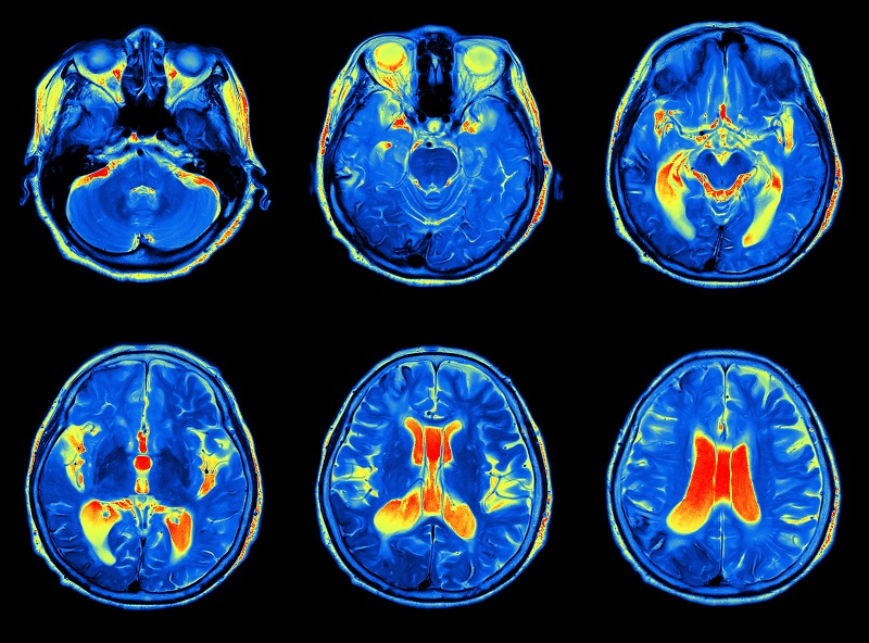 Can Cannabis Injectables Provide Relief from Seizure Related Disorders?