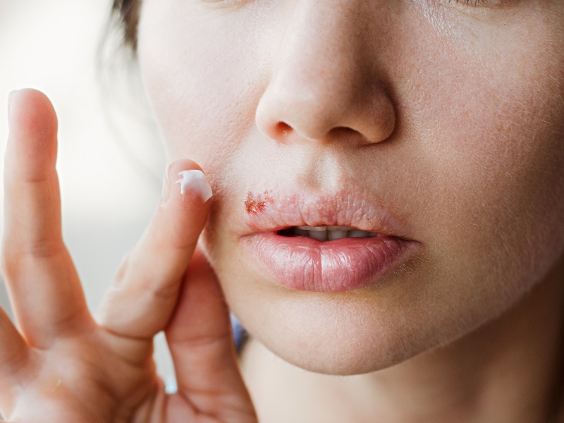 How to Treat Cold Sores with Topical CBD