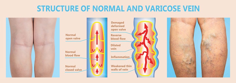 The Case for CBD Oil as a Treatment for Venous Insufficiency & DVT